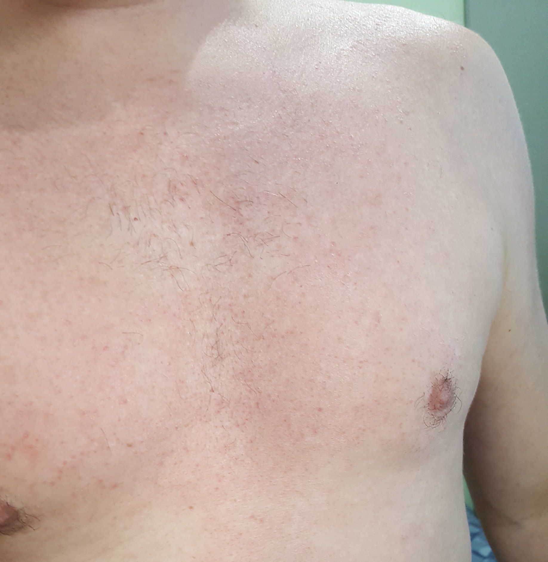 Peito e tronco após Tend Skin — foliculite tratada e vermelhidão reduzida